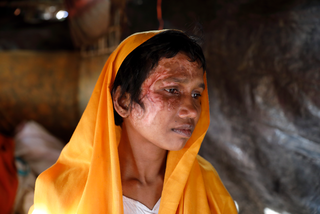 von Brandwunden gezeichnet: Misshandelte Rohingya aus Myanmar